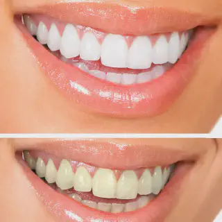 /img/30136-teeth-whitening-indianapolis-cost-factors.webp