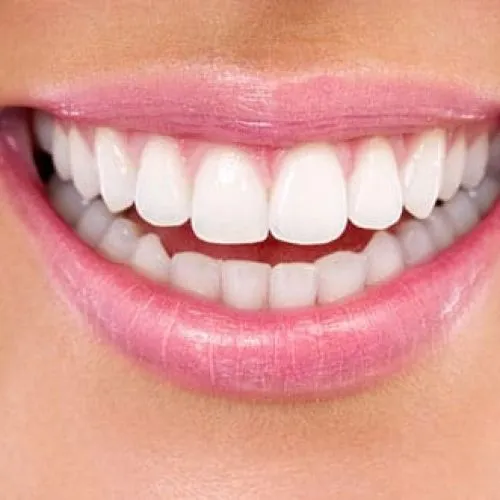 30136 teeth whitening indianapolis take home kit