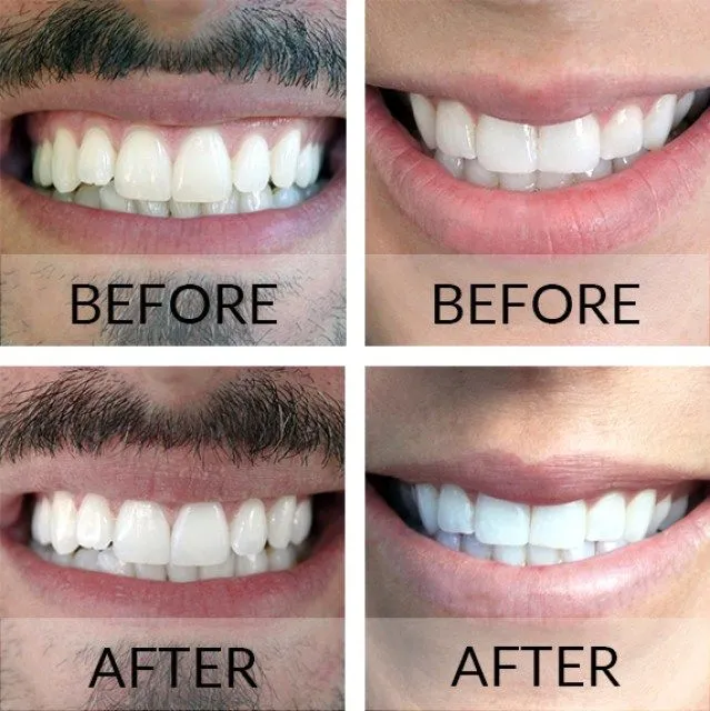 30137 teeth whitening aftercare