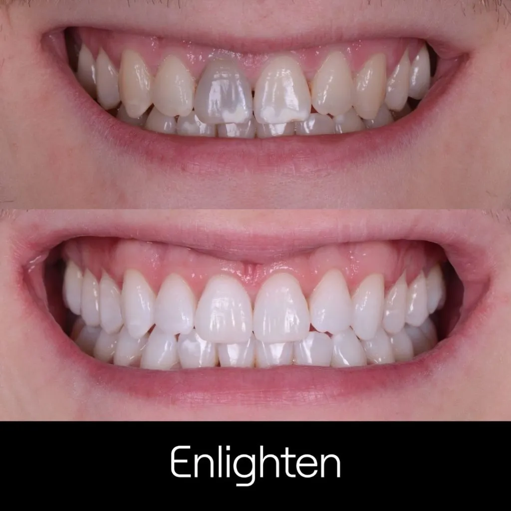 30142 types of teeth whitening gel