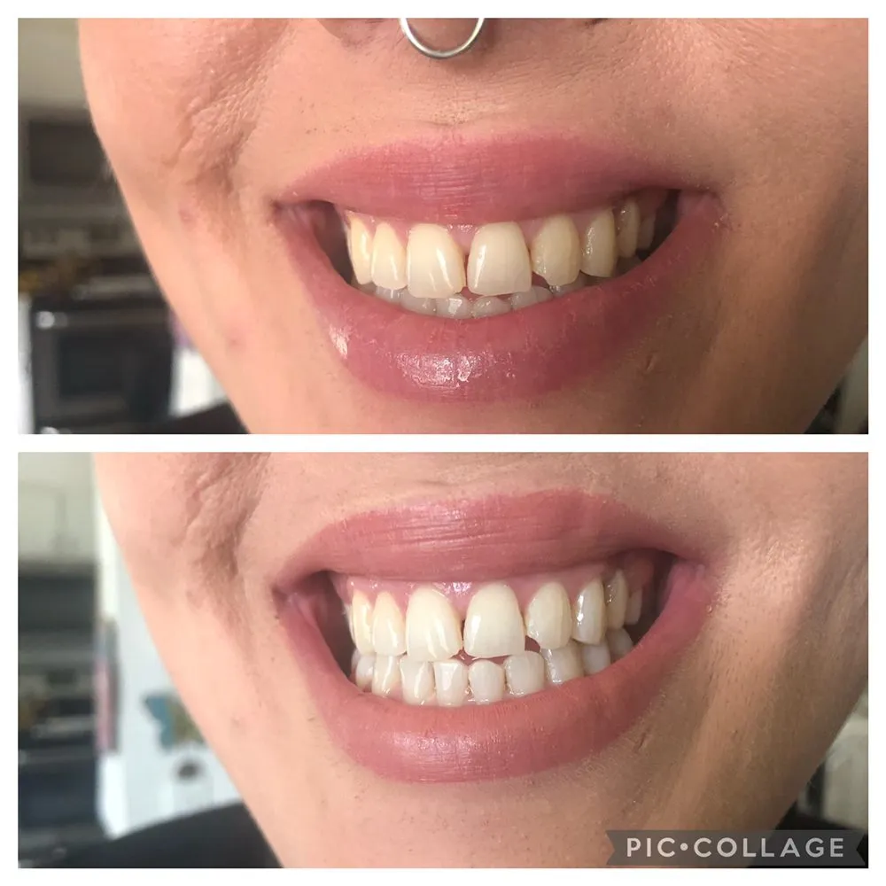 30148 spokane teeth whitening before after