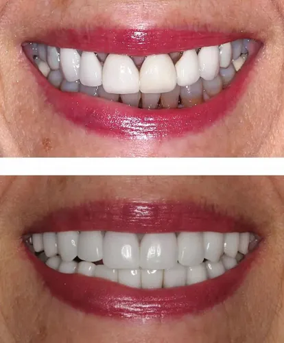 30149 teeth whitening longevity
