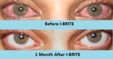 30151 red eye causes