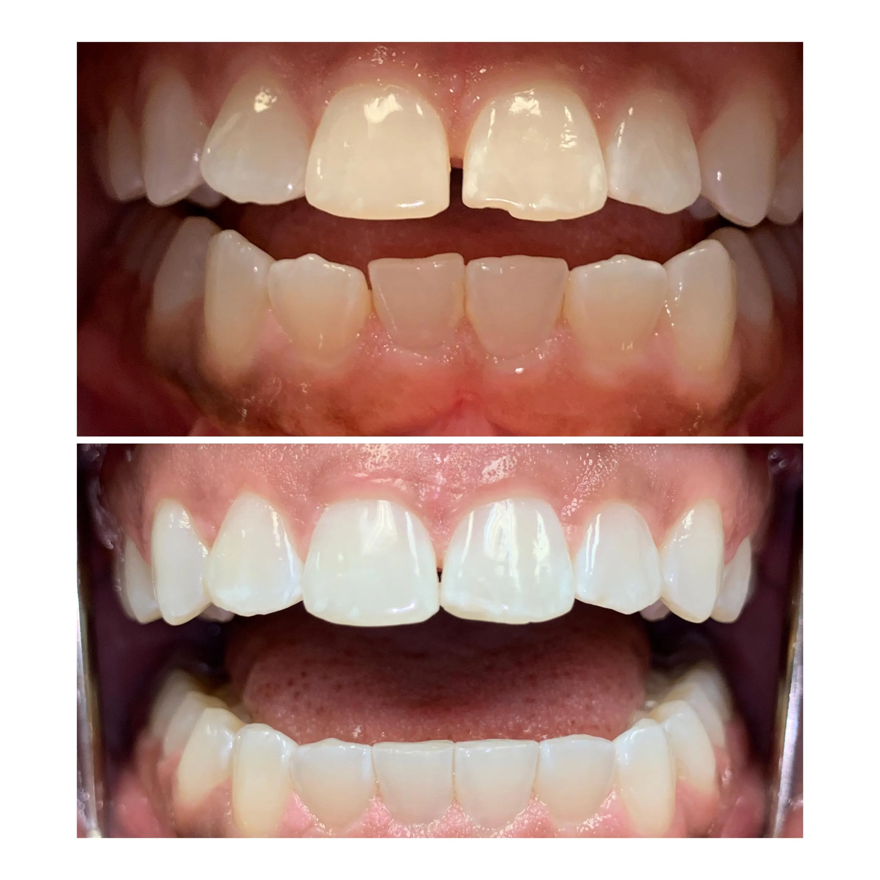 30160 invisalign patient smile