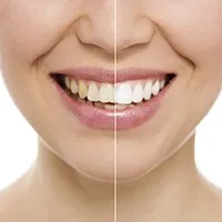 30165 professional teeth whitening