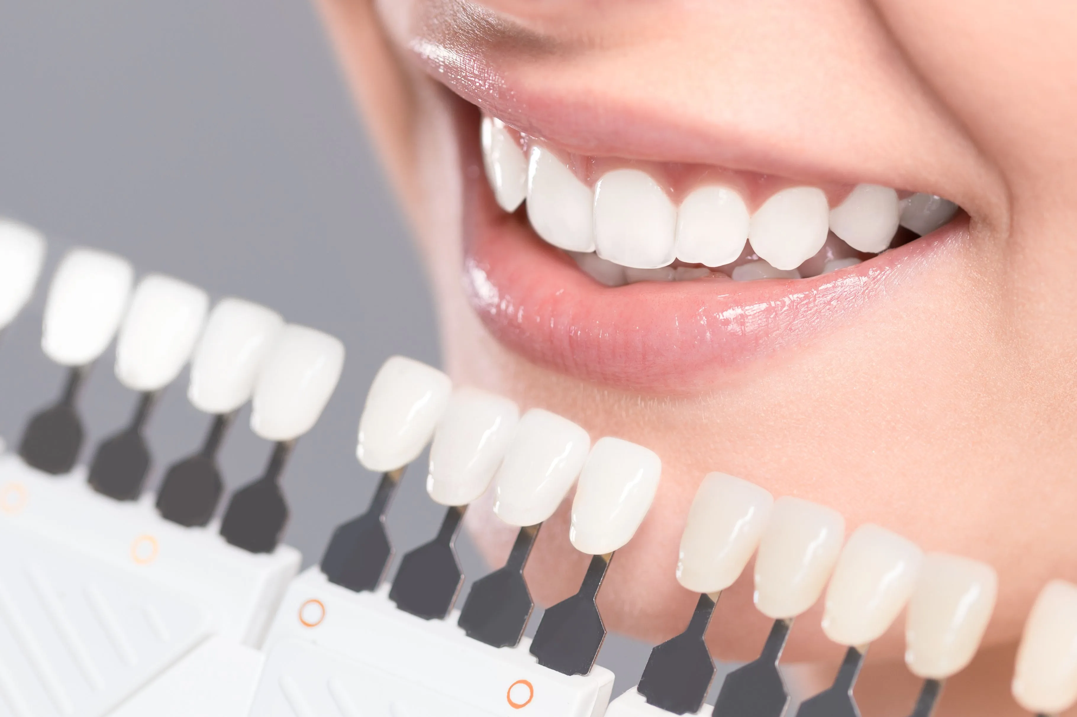 30167 cost of teeth whitening