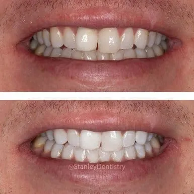 30167 zoom whitening