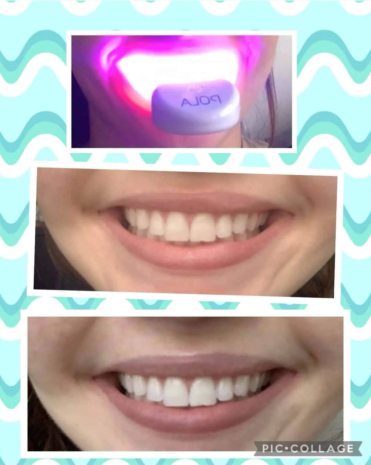 30173 teeth whitening sensitivity