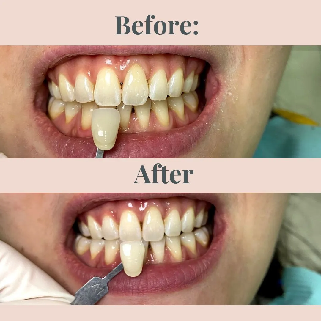 30174 in office teeth whitening