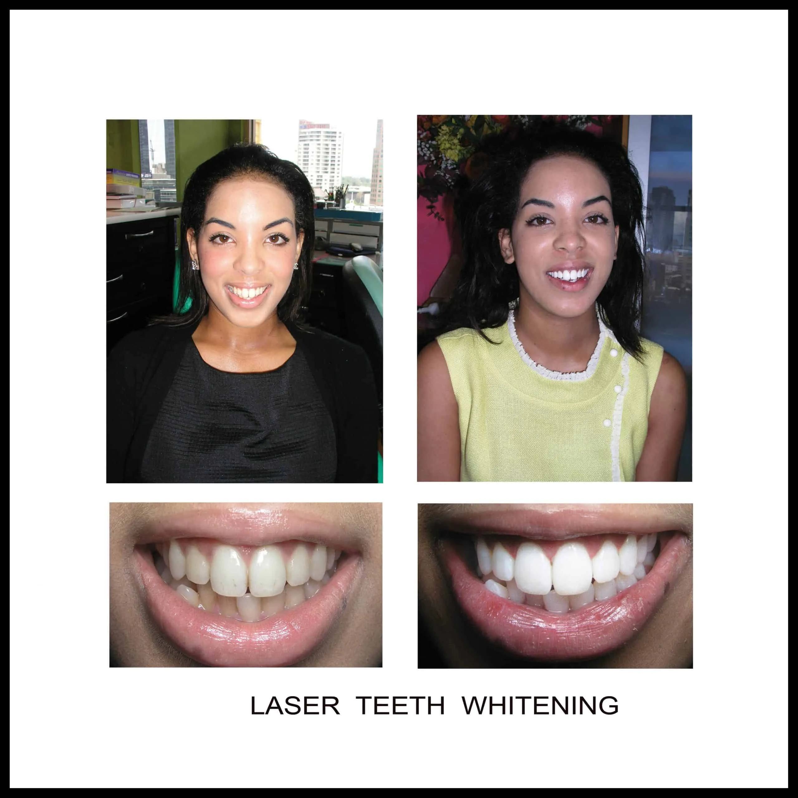 30175 in office teeth whitening