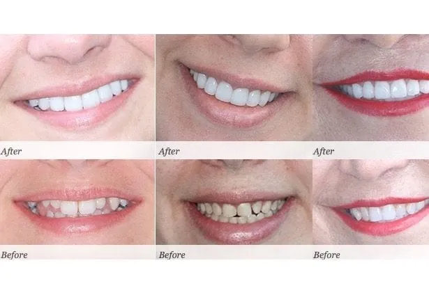30175 teeth whitening before after