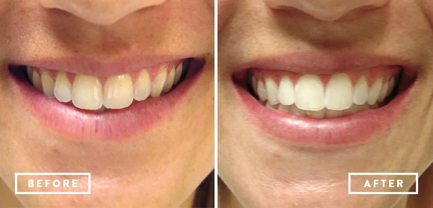 30176 fluoride treatment