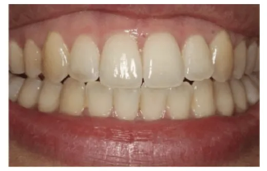30177 teeth whitening options