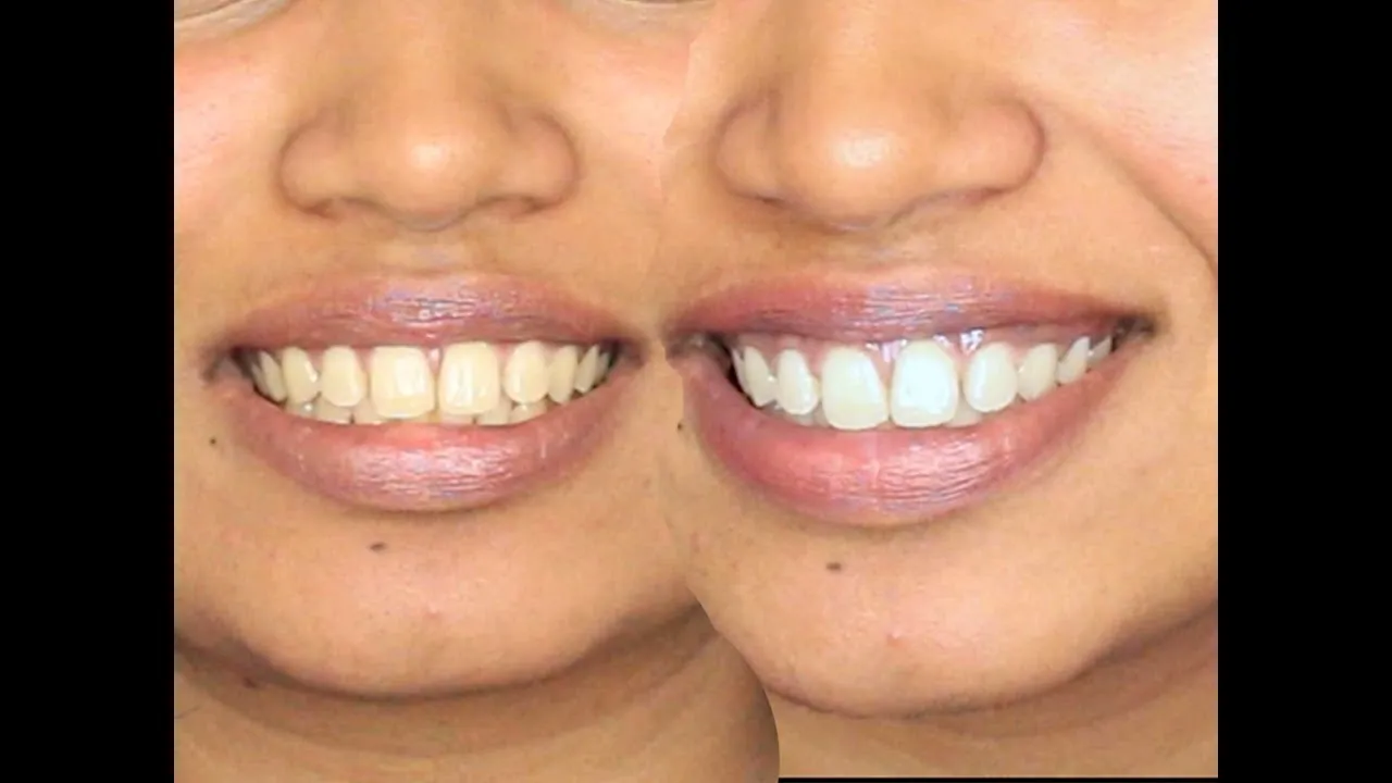 30180 healthy gums