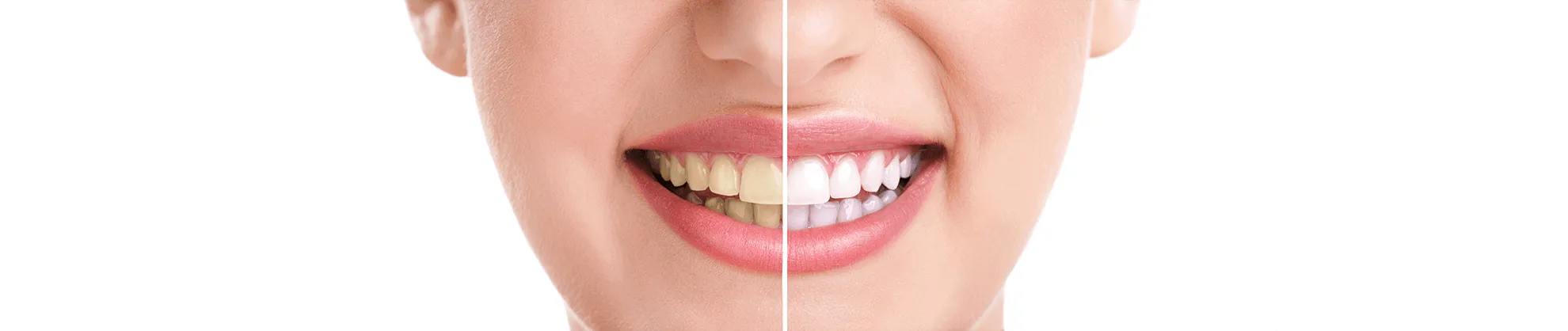 /img/30181-teeth-whitening-procedure.webp
