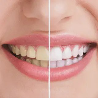 /img/30181-teeth-whitening-procedure.webp