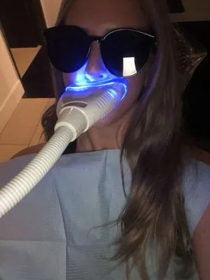 30187 at home teeth whitening kit