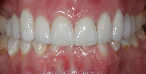 30190 berries teeth whitening