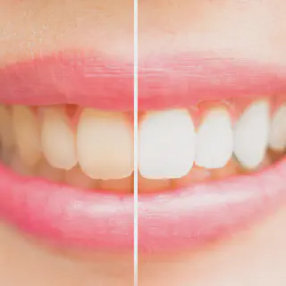 /img/30190-oral-hygiene-teeth-whitening.webp