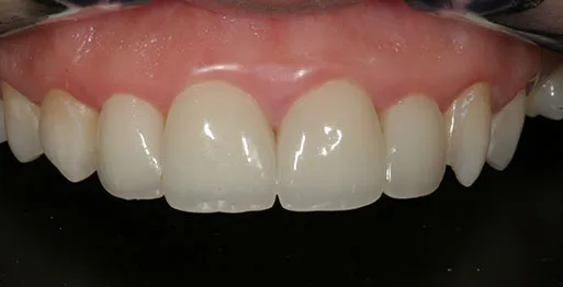 30190 red wine teeth whitening