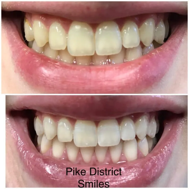 30191 teeth whitening rockville md image1