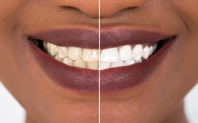 30191 teeth whitening rockville md image2