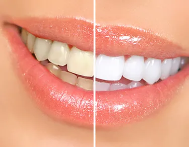 30196 teeth whitening shirley