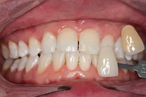 30196 whitening kit shirley