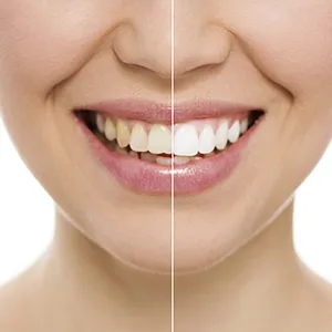 30200 pasadena teeth whitening diet