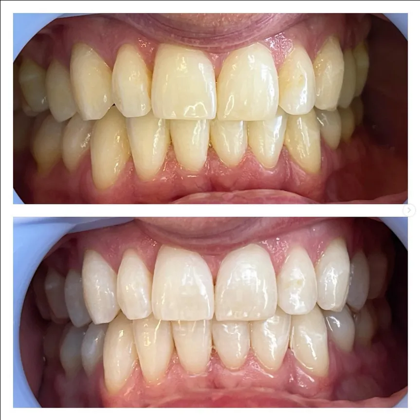 30201 minimally invasive