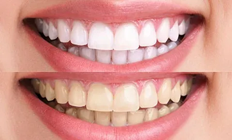 /img/30207-laser-teeth-whitening-cost.webp