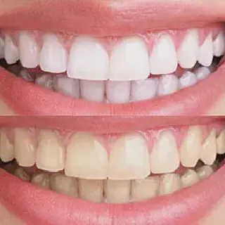 /img/30207-laser-teeth-whitening-cost.webp