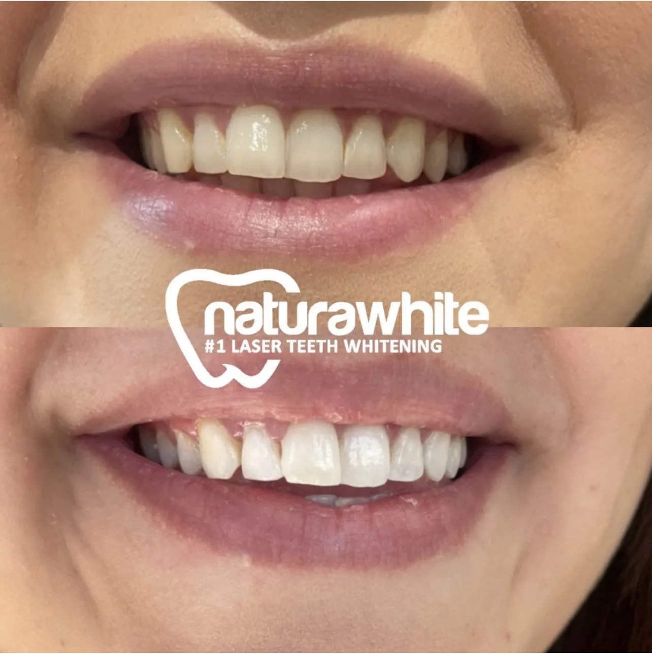 30207 teeth whitening before after