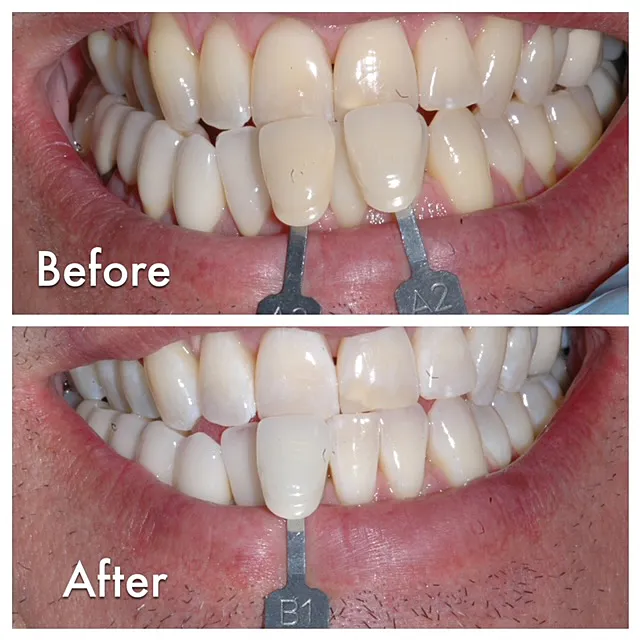 30207 teeth whitening process