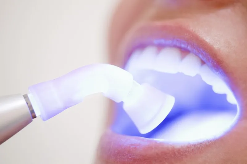30209 at home teeth whitening
