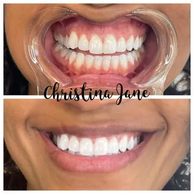 30209 teeth whitening sensitivity