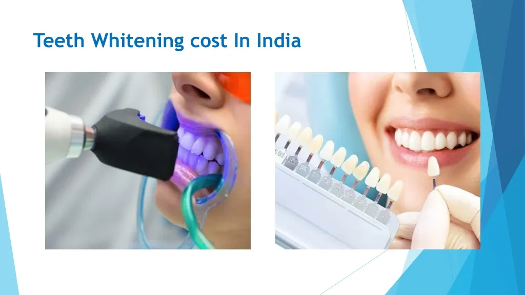 30212 at home teeth whitening kits