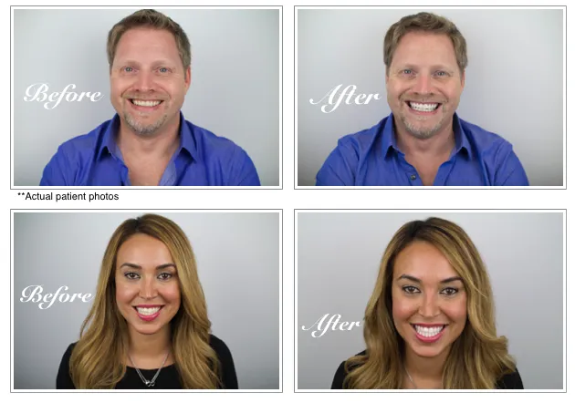 30213 teeth whitening oc home kit