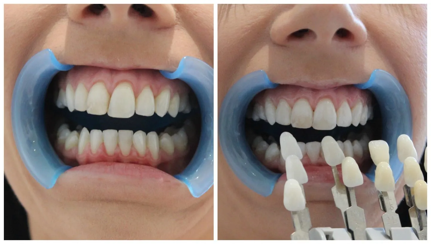 30213 teeth whitening oc in office