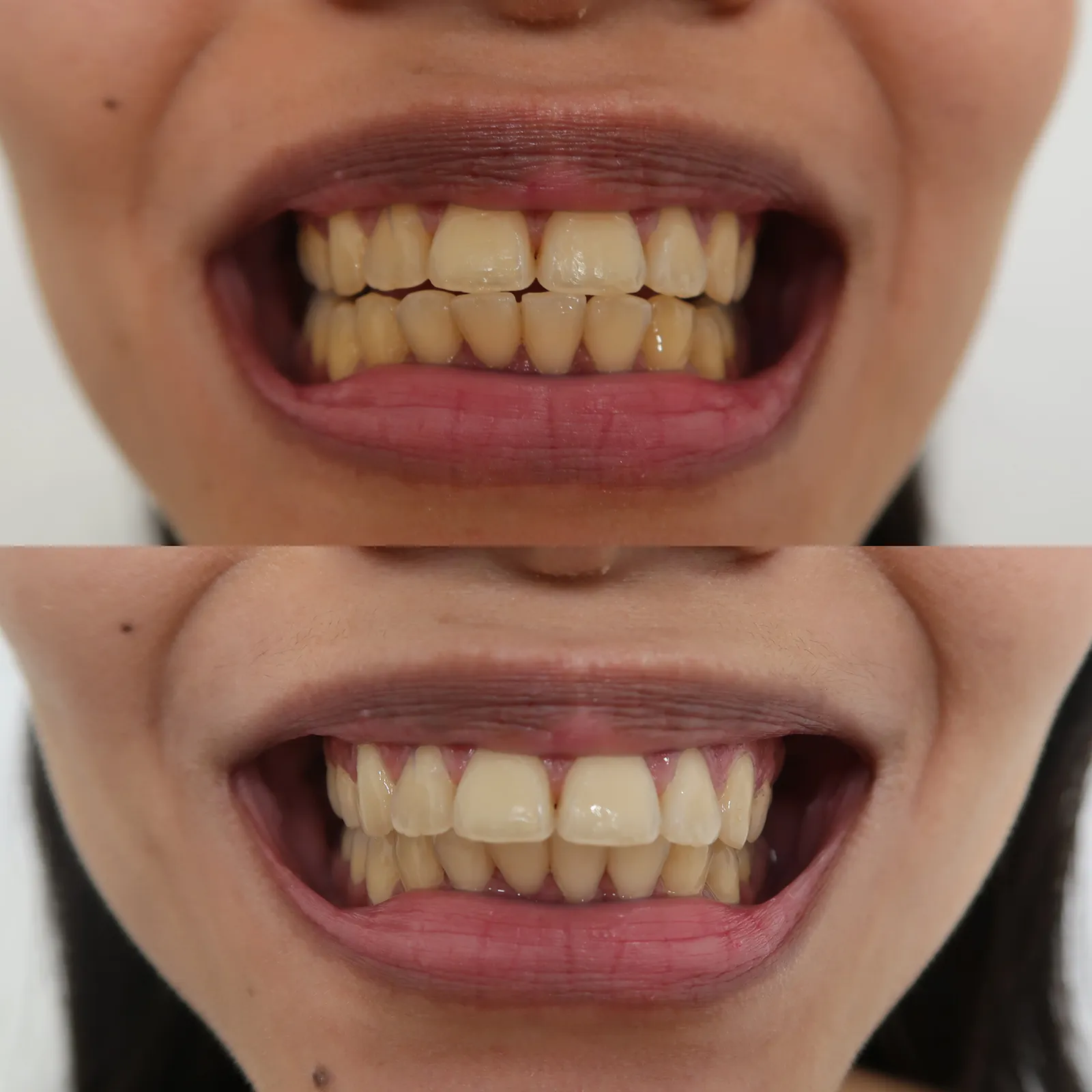 30215 teeth whitening alternatives