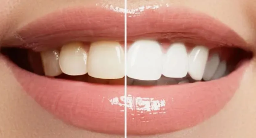 30217 teeth whitening procedure