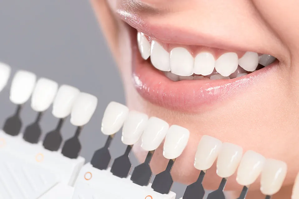 30217 teeth whitening professional san jose