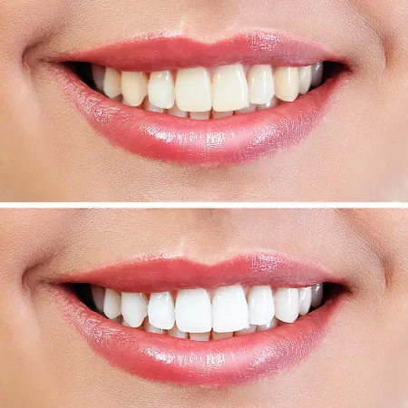 30217 teeth whitening sensitivity