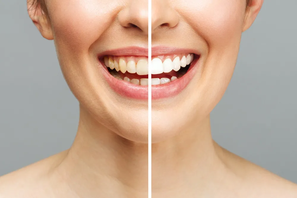 /img/30217-teeth-whitening-smile.webp