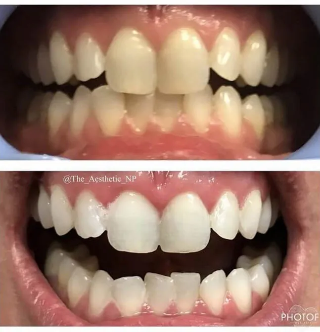 30220 teeth whitening manchester nh 1