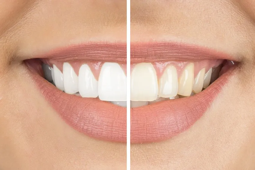 30220 teeth whitening manchester nh 2