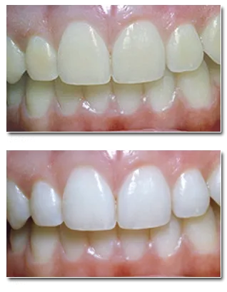 30220 teeth whitening manchester nh 3