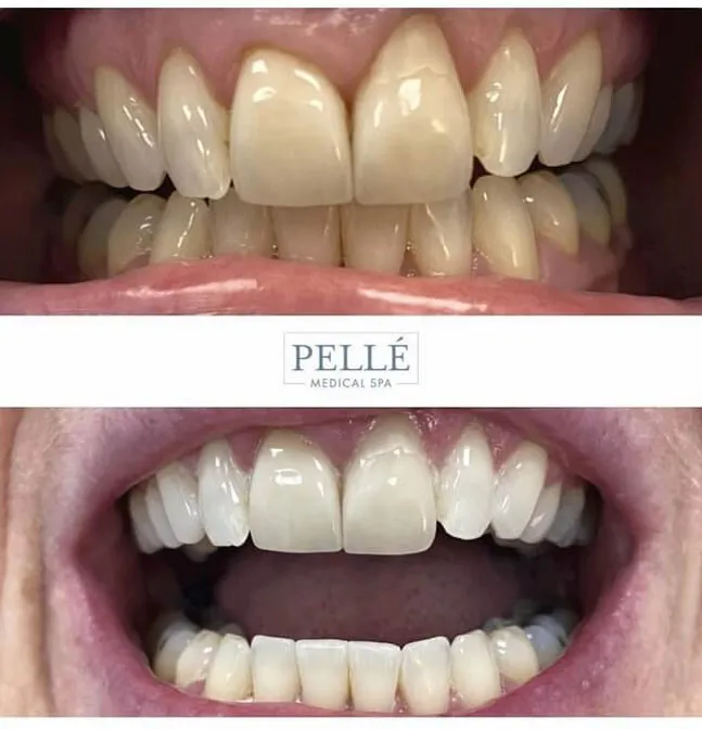 30220 teeth whitening manchester nh 4