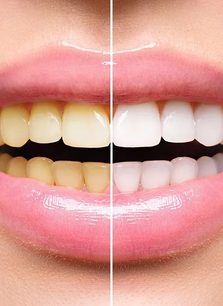30220 teeth whitening manchester nh 5