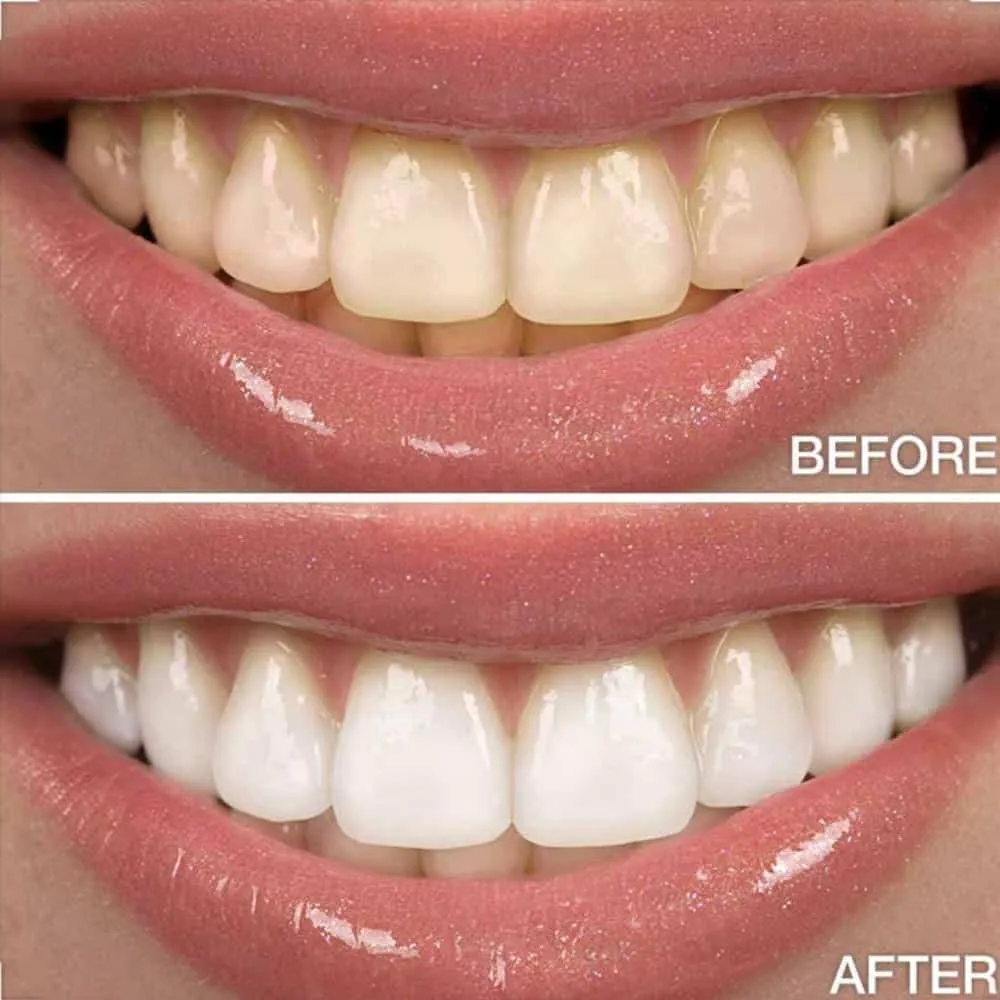 30223 arctic teeth whitening encino happy patient